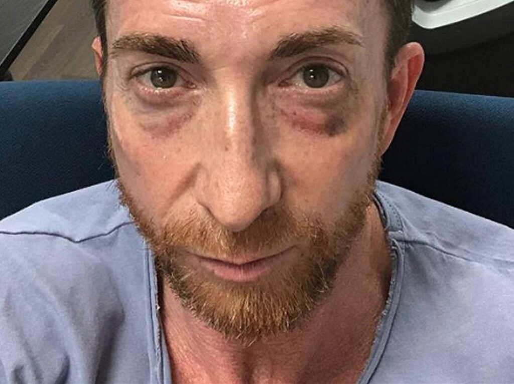 Ojos Panda (Black Eye Pedo and Panda Eyes)