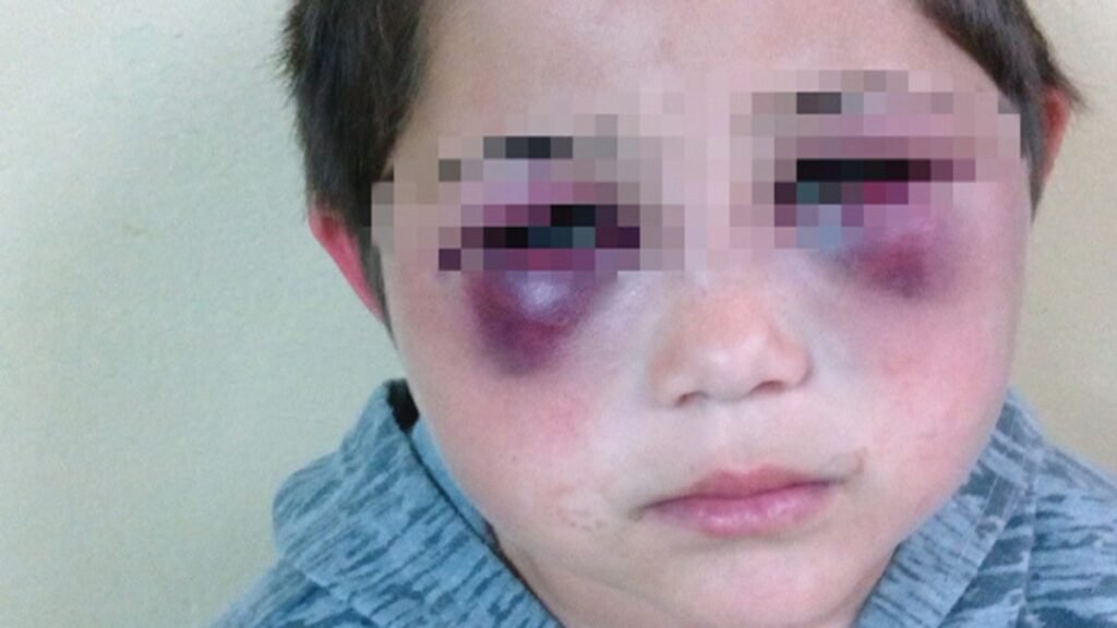 Ojos Panda (Black Eye Pedo and Panda Eyes)