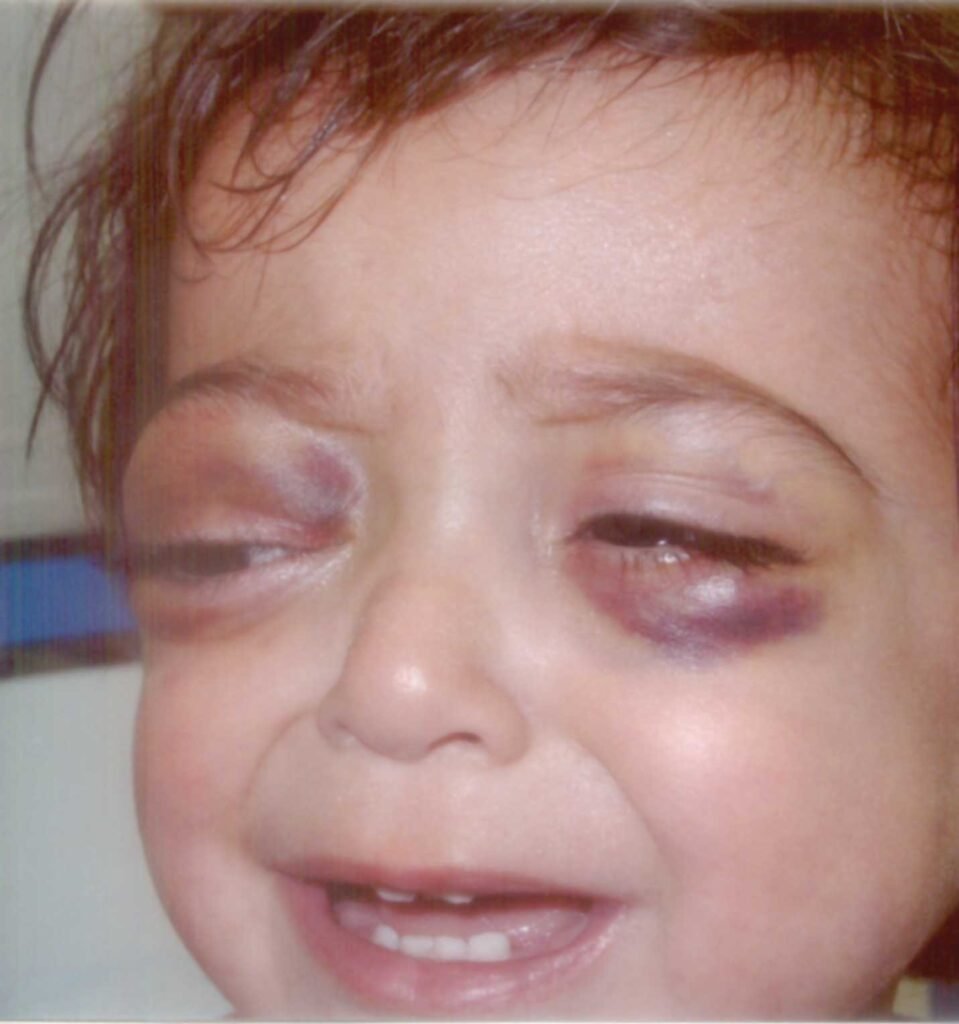 Ojos Panda (Black Eye Pedo and Panda Eyes)