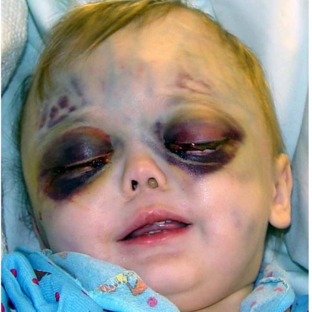 Ojos Panda (Black Eye Pedo and Panda Eyes)